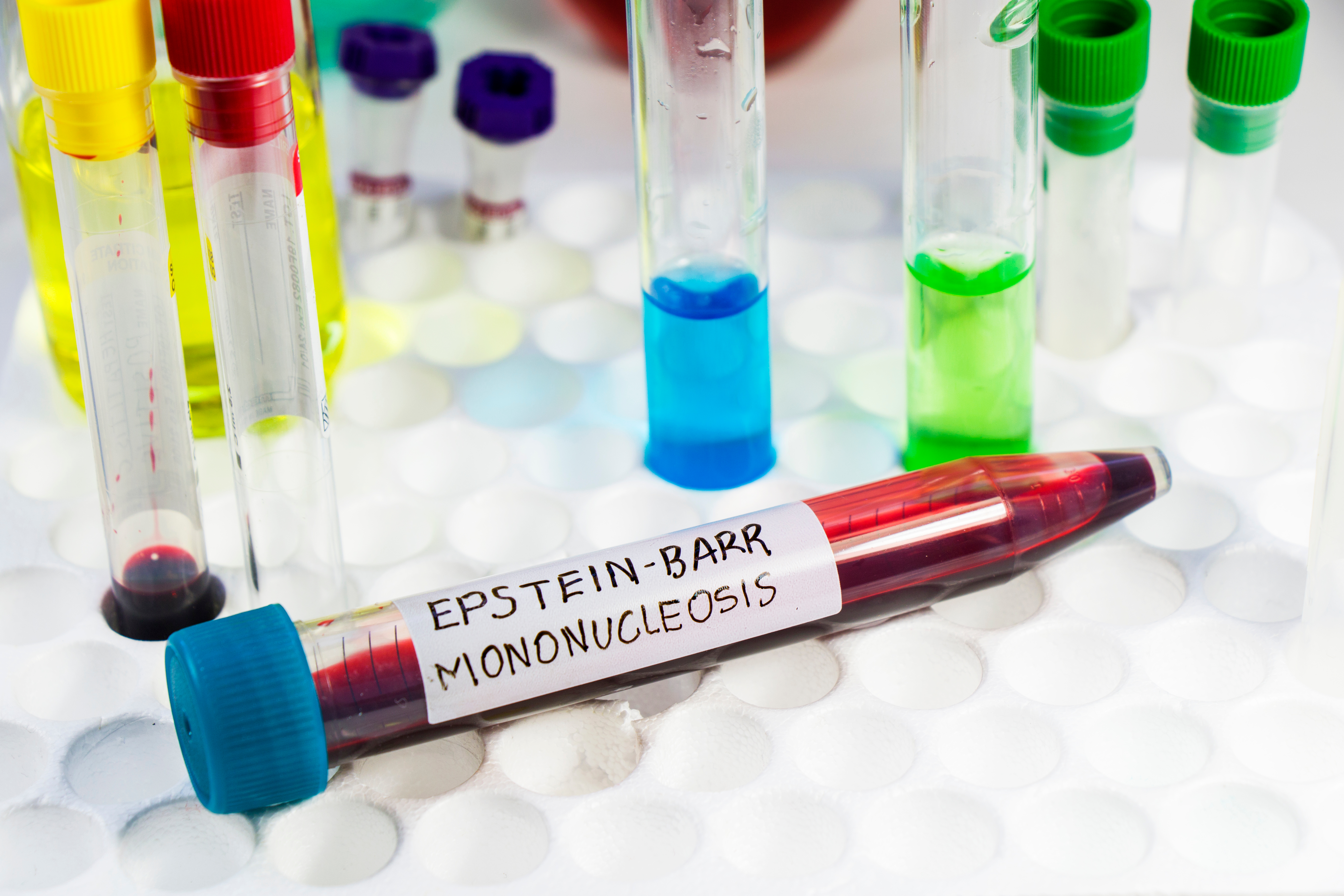 Mononucleosis and Epstein-Barr virus blood test sample in lab.