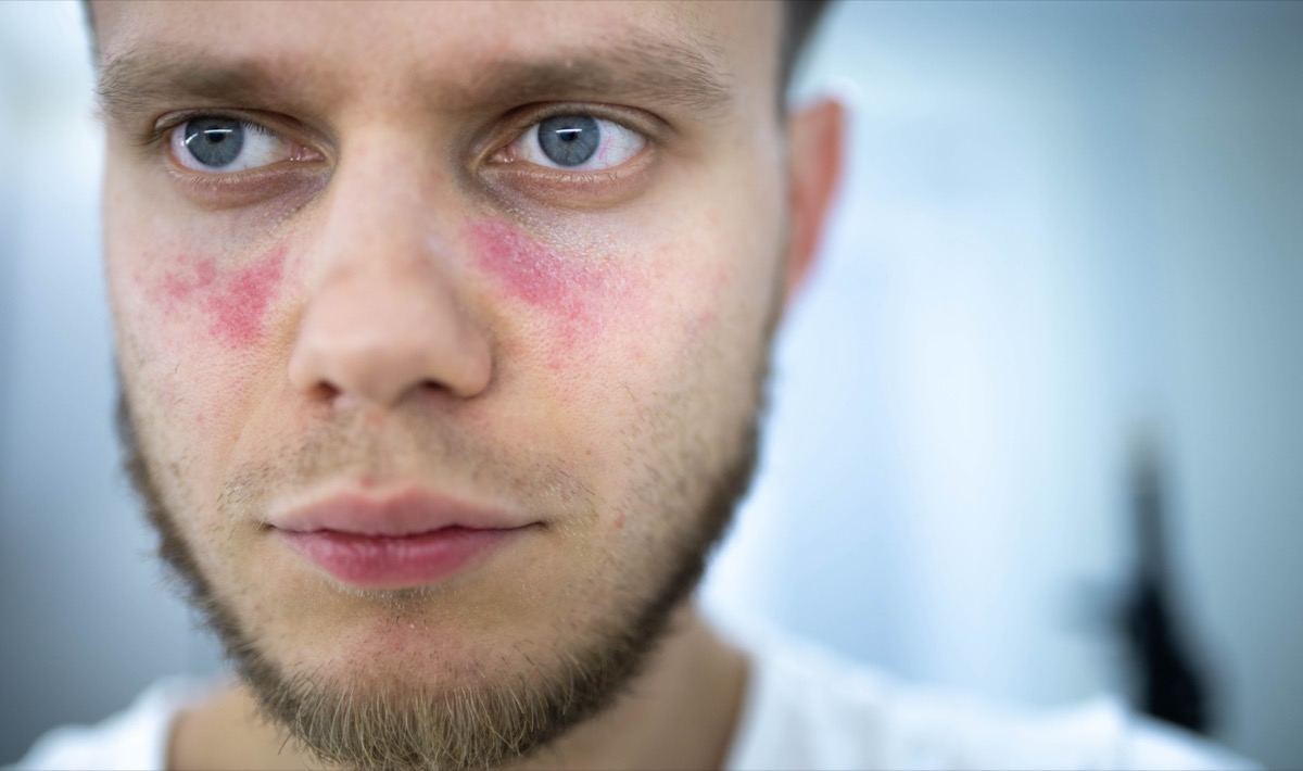 Spots of redness on the face, a young man is sick systemic lupus erythematosus