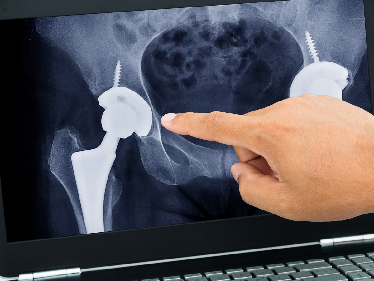 Doctor points at a X-ray image of a hip implant.