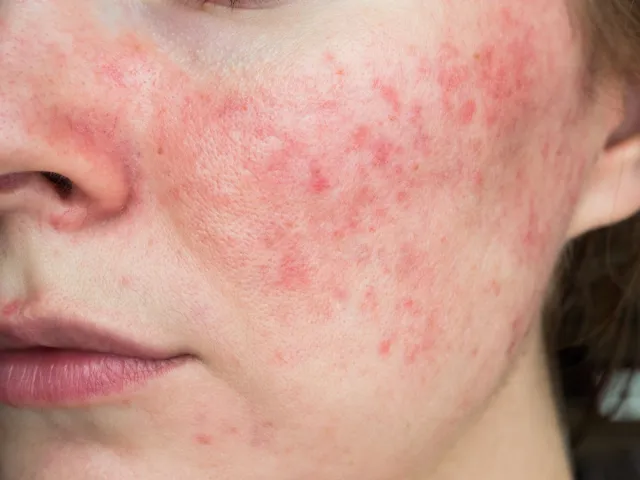 Woman with a rash on her face—papulopustular rosacea.