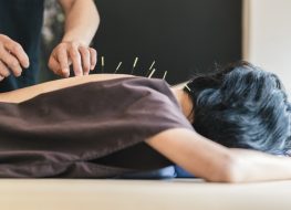 woman getting acupuncture on back on table