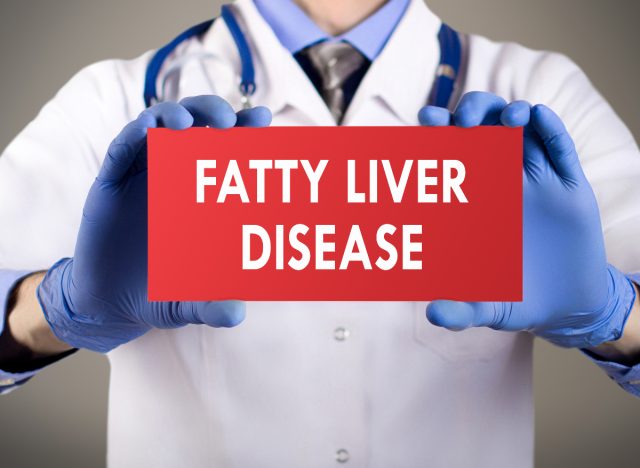 doctor holding up fatty liver disease sign