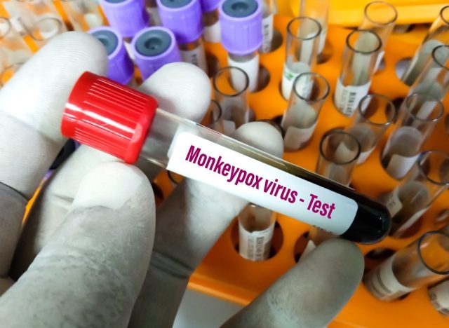 Blood sample tube for Monkeypox virus test.