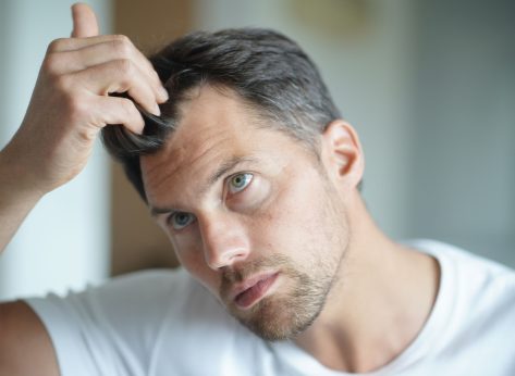 man hair loss