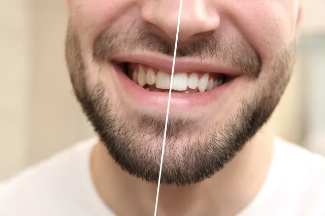 Man smiling white teeth