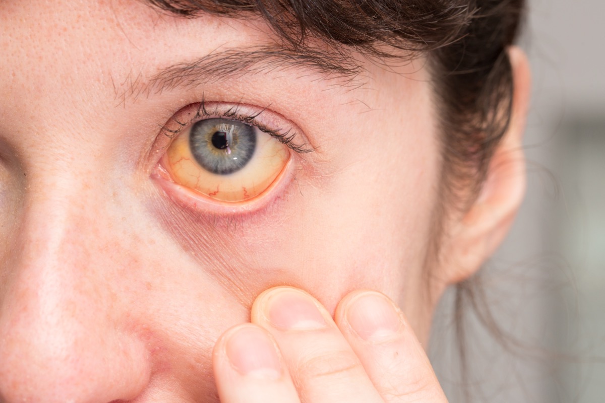 Close up,Of,Girl's,Eye,With,Yellow,Sclera,Caused,By,Jaundice