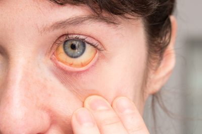 Pancreatic Cancer Is Often Diagnosed at a Late Stage: Know the Signs and Symptoms