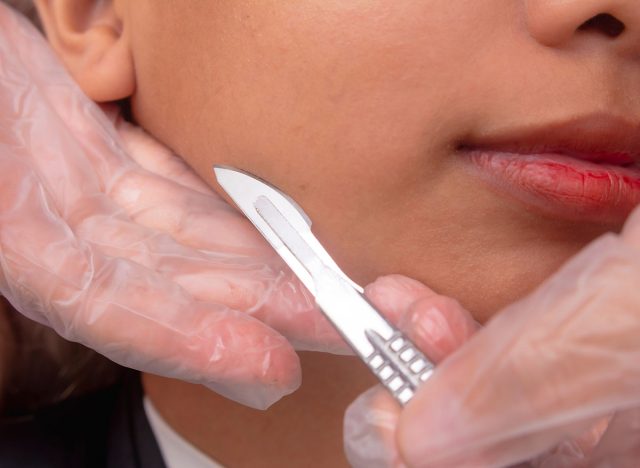 Close-up of dermaplaning or microplaning procedure to closely shave and exfoliating the skin.