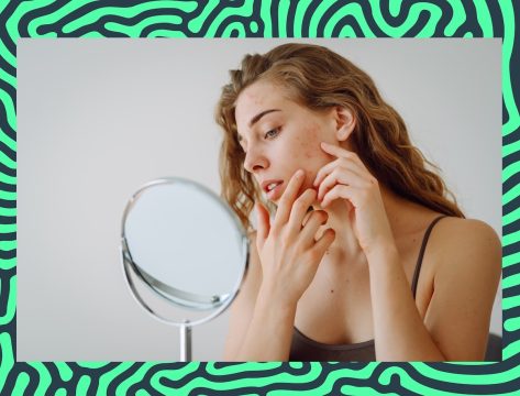 7 Foods That Trigger Adult Acne