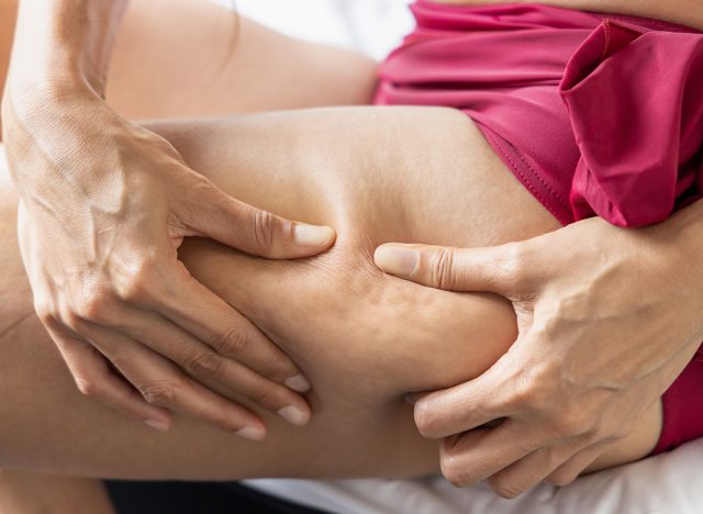 fat woman's leg, fatty leg with uneven cellulite skin, woman hand holding excessive thigh fat, overweight fat leg of woman, woman body care lifestyle concept of wrinkled thigh skin and cellulite